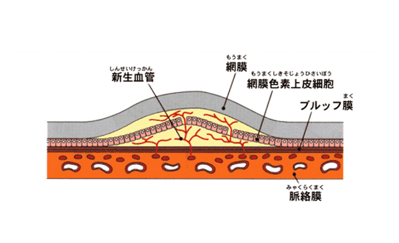 加齢性黄斑変性 | 診療内容 | 南眼科