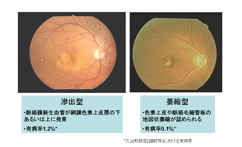 加 齢 黄斑 変性 用 の メガネ